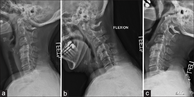 Safety And Efficacy Of Lateral Mass Screws At C7 In The Treatment Of