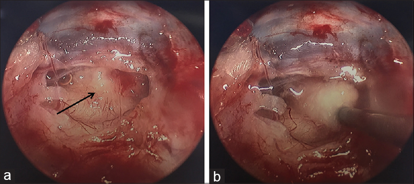 Suprasellar keratinous cyst: A case report and review on its