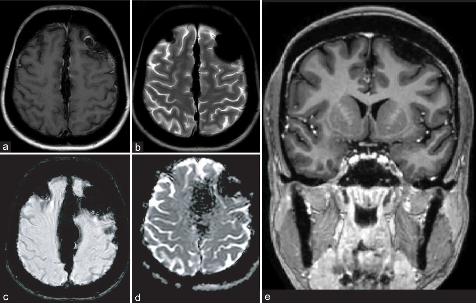 Surgical Neurology International