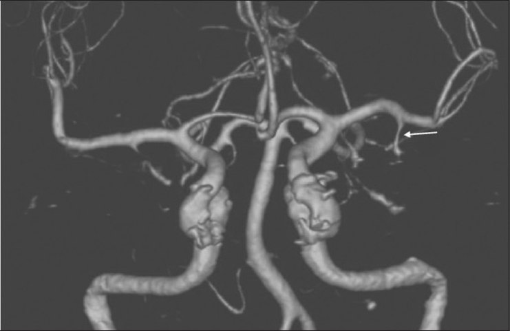 Endovascular management of fusiform aneurysm of anterior temporal ...