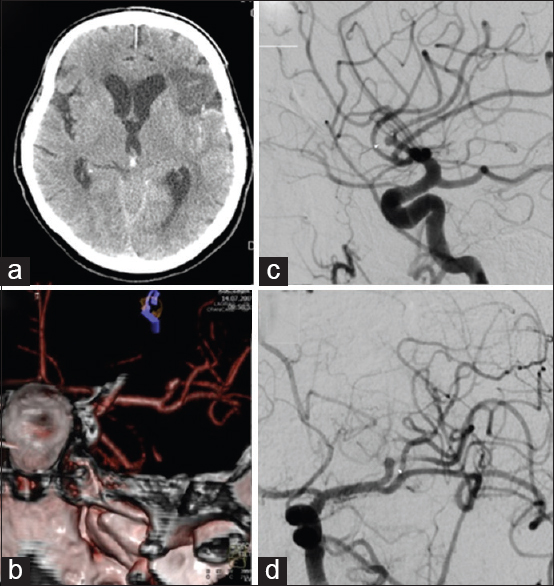 Middle cerebral artery fusiform aneurysm presented with stroke and ...