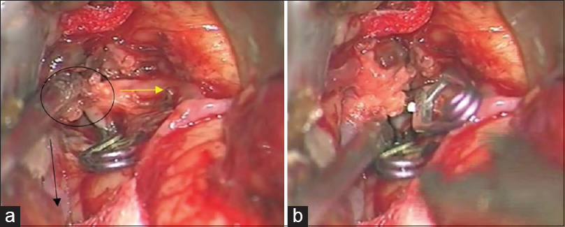 Middle cerebral artery fusiform aneurysm presented with stroke and ...