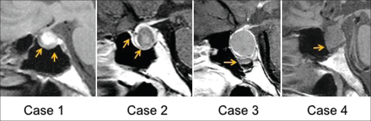 Clinical Significance Of Thickened Sphenoid Sinus Mucosa In Rathke s 