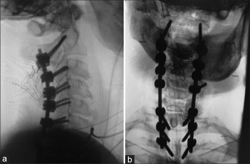 Axial and oblique C2 pedicle diameters and feasibility of C2 pedicle