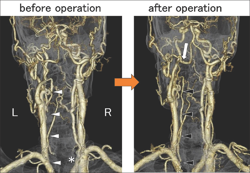 occipital-artery-to-extracranial-vertebral-artery-anastomosis-for