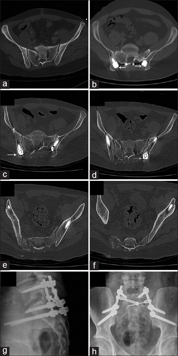 Fluoroscopy only for the placement of long iliac screws: A study on 14