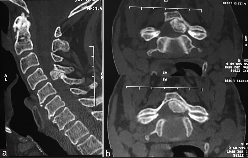 Ossification of the cervical ligamentum flavum and case ...