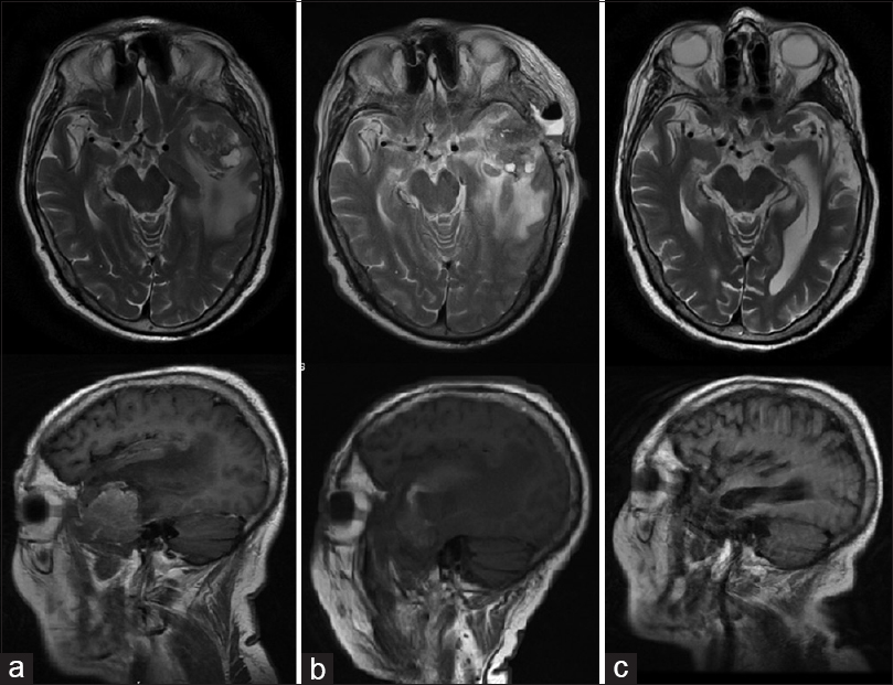 Preliminary experience in the management of brain and skull-base tumors ...