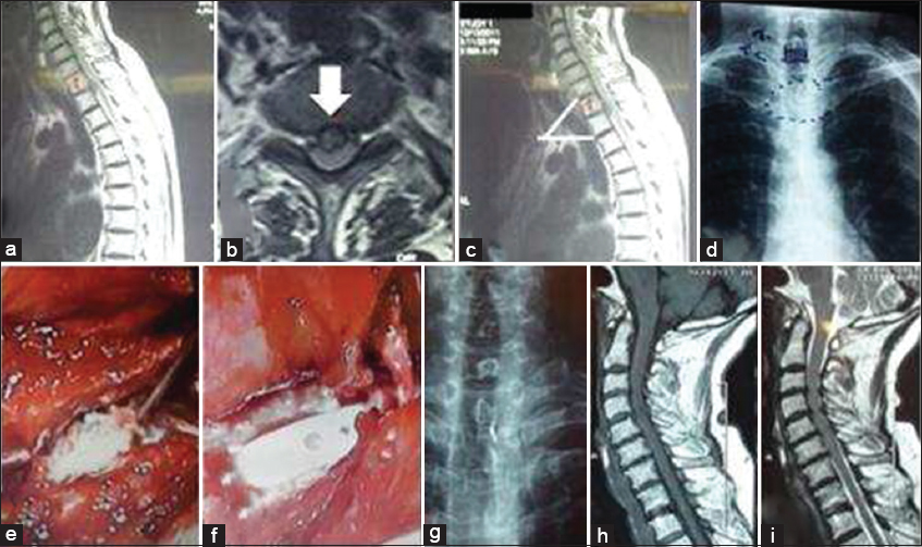 T1 T2 Disc Herniation Report Of Four Cases And Review Of The Literature Surgical Neurology International