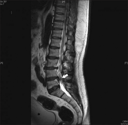 Spinal Cord Ischemia Infarct After Cauda Equina Syndrome From Disc Herniation A Case Study And Literature Review Surgical Neurology International