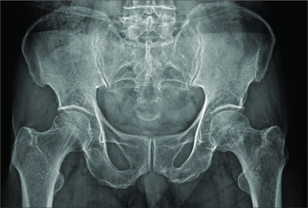 normal hip xray compared to oa