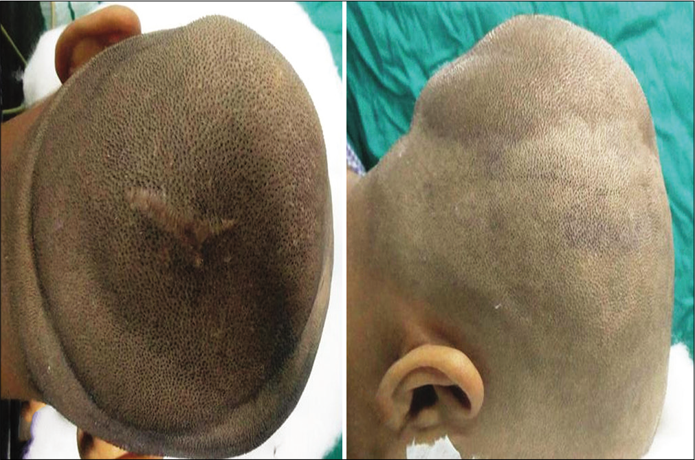 Rapidly growing diffuse neurofibroma of the scalp with ...