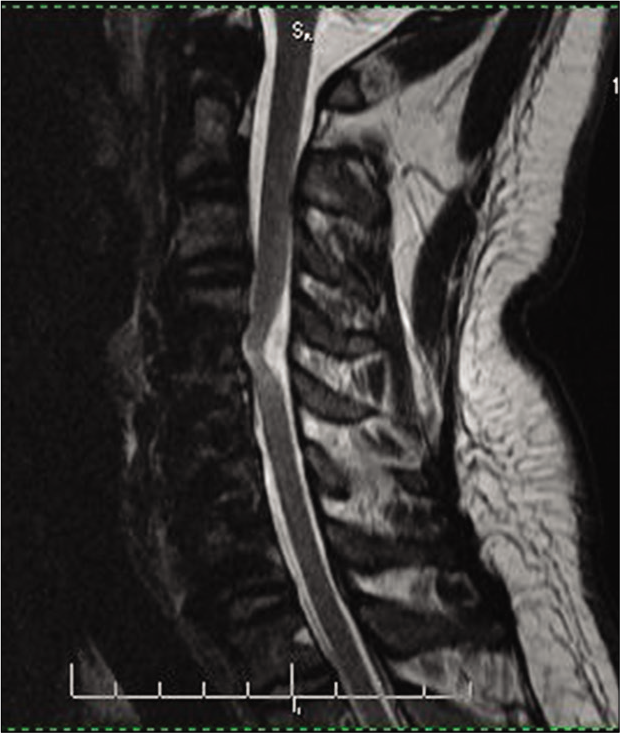 Spinal Cord Herniation Following Multilevel Anterior Cervical My Xxx