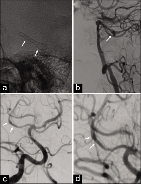 Fusiform superior cerebellar artery aneurysm treated with flow ...