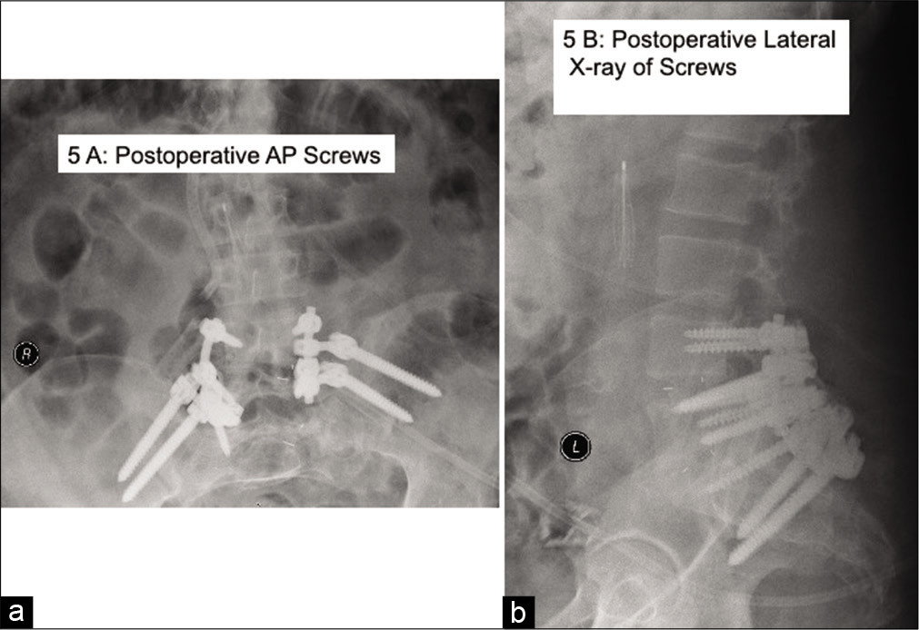 Reconstruction of Shattered Lumbo-Sacral Junction/Pelvis Utilizing