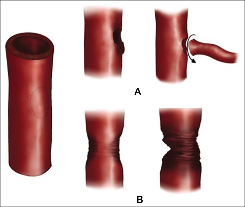 classification-of-internal-carotid-artery-injuries-during-endoscopic