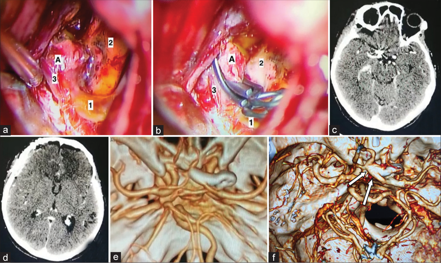 Successful microsurgical clipping of ruptured fusiform aneurysm of the ...