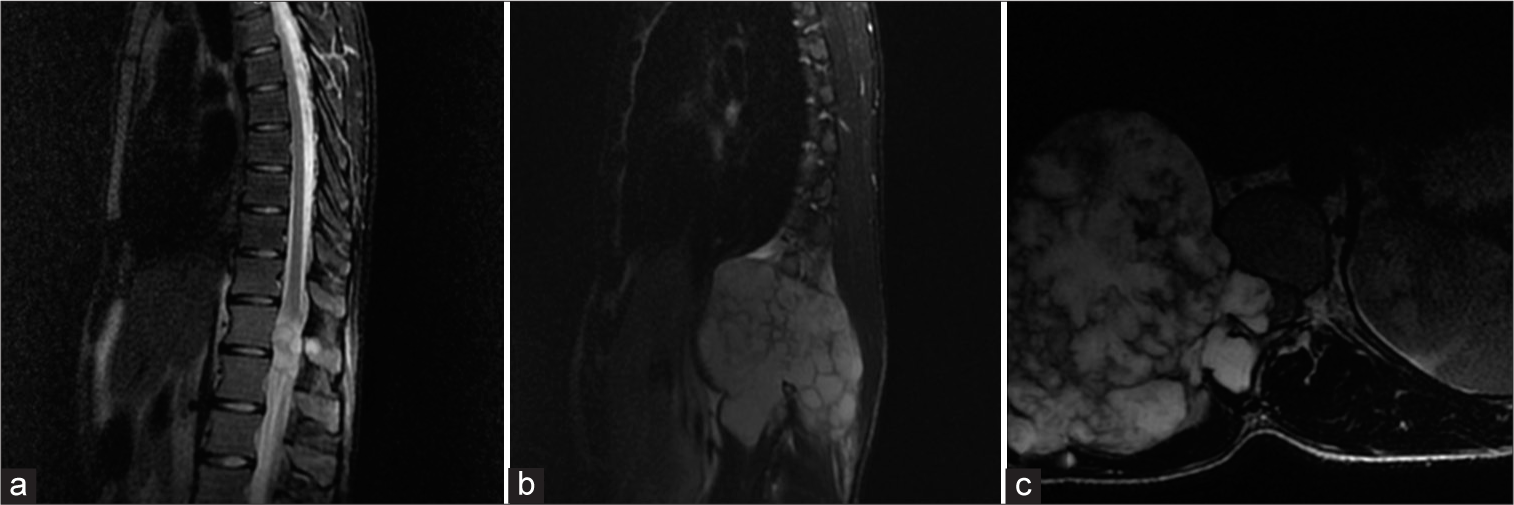 Hereditary multiple exostoses with spinal cord compression.