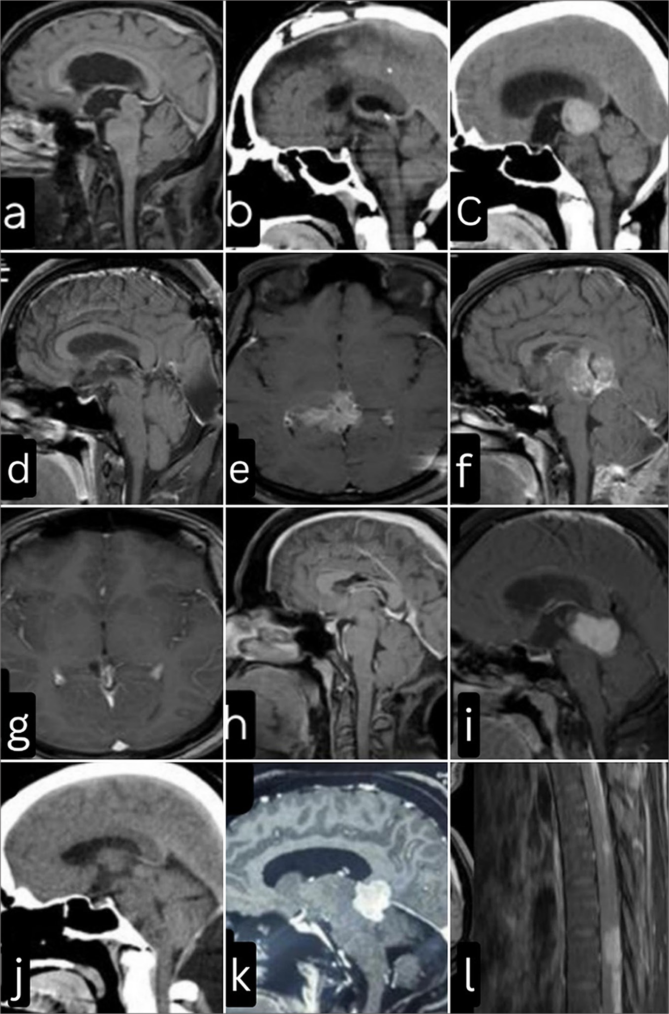 Surgical Neurology International